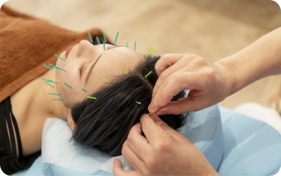 美容鍼